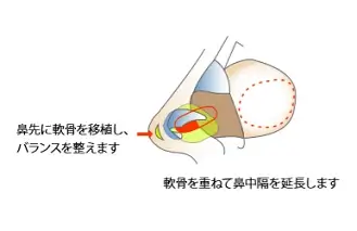 軟骨移植・鼻中隔延長イラスト
