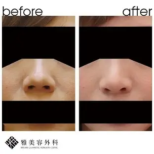 Before After（正面）