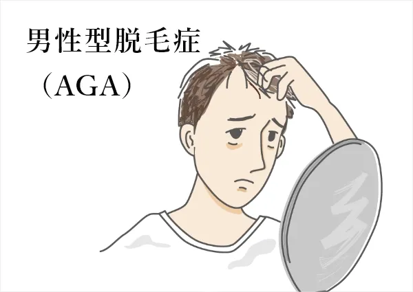 男性型脱毛症（AGA）の治療について