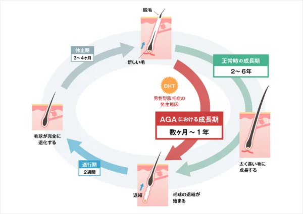 男性型脱毛症（AGA）の仕組み