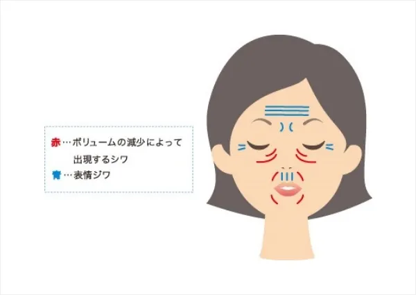 しわの種類