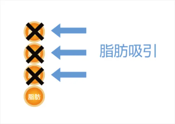 脂肪吸引による部分痩せ