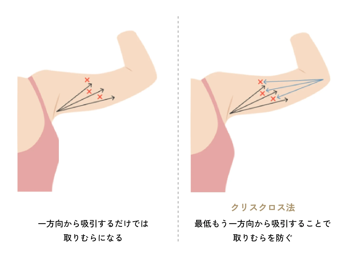 脂肪吸引の基本「クリスクロス法」