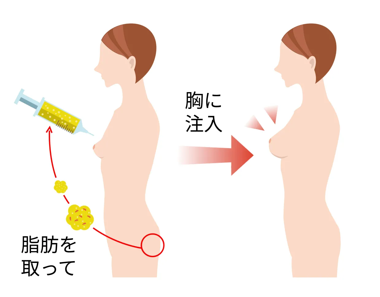 脂肪注入豊胸