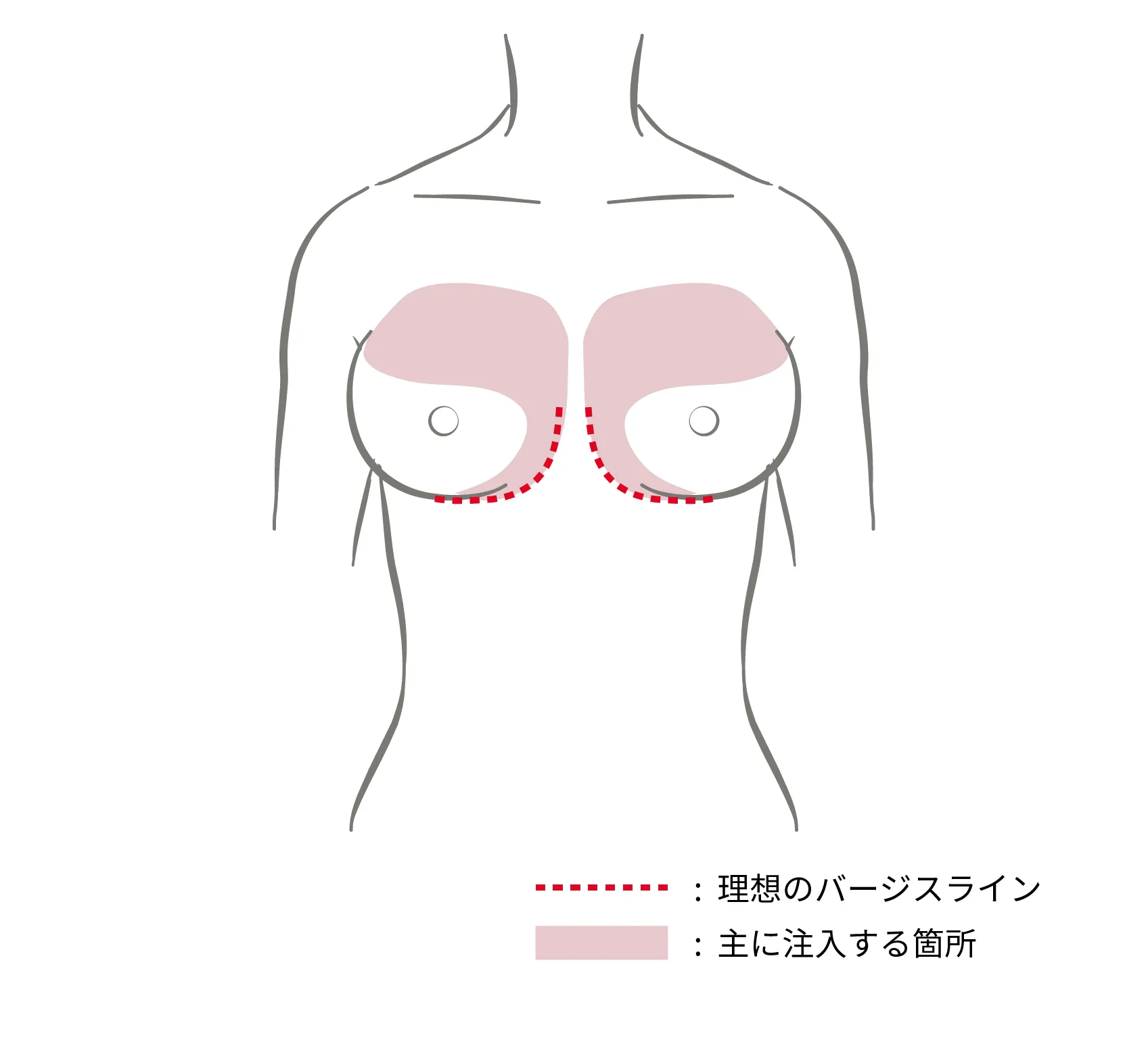 離れ胸タイプ（注入ポイント）
