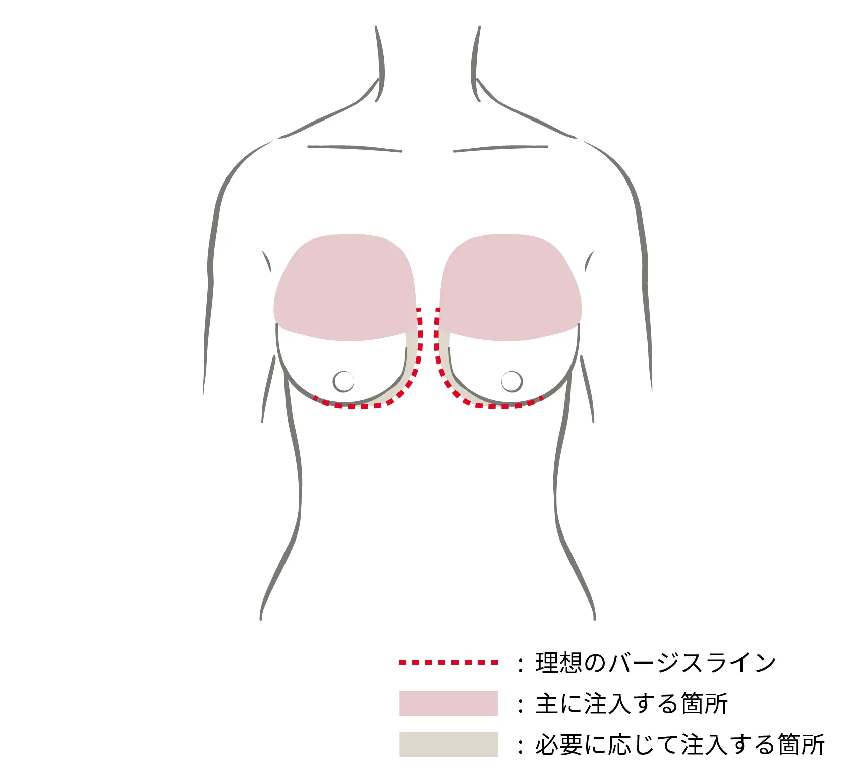 垂れ胸タイプ（注入ポイント）