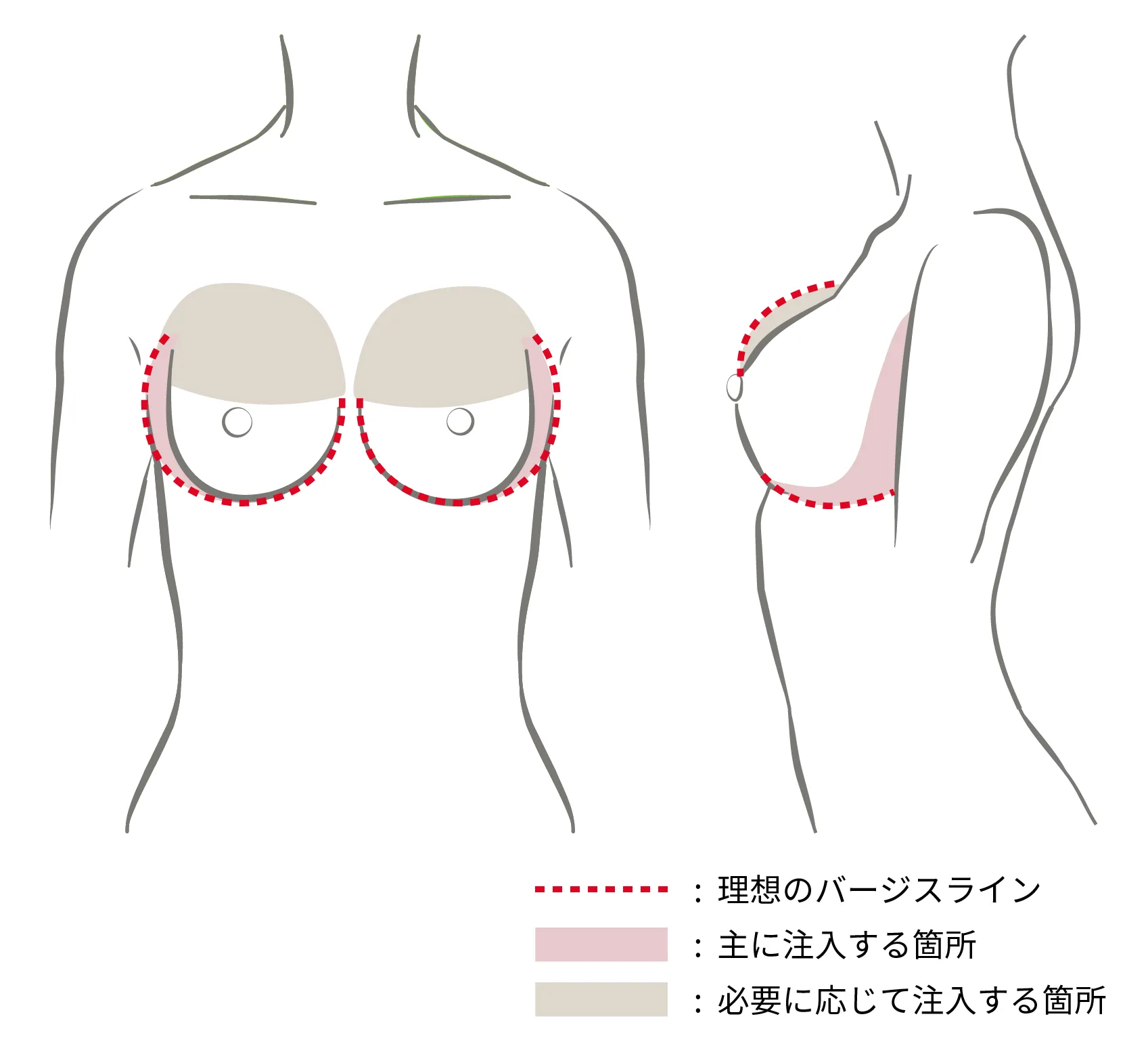 外側が痩せているタイプ（注入ポイント）