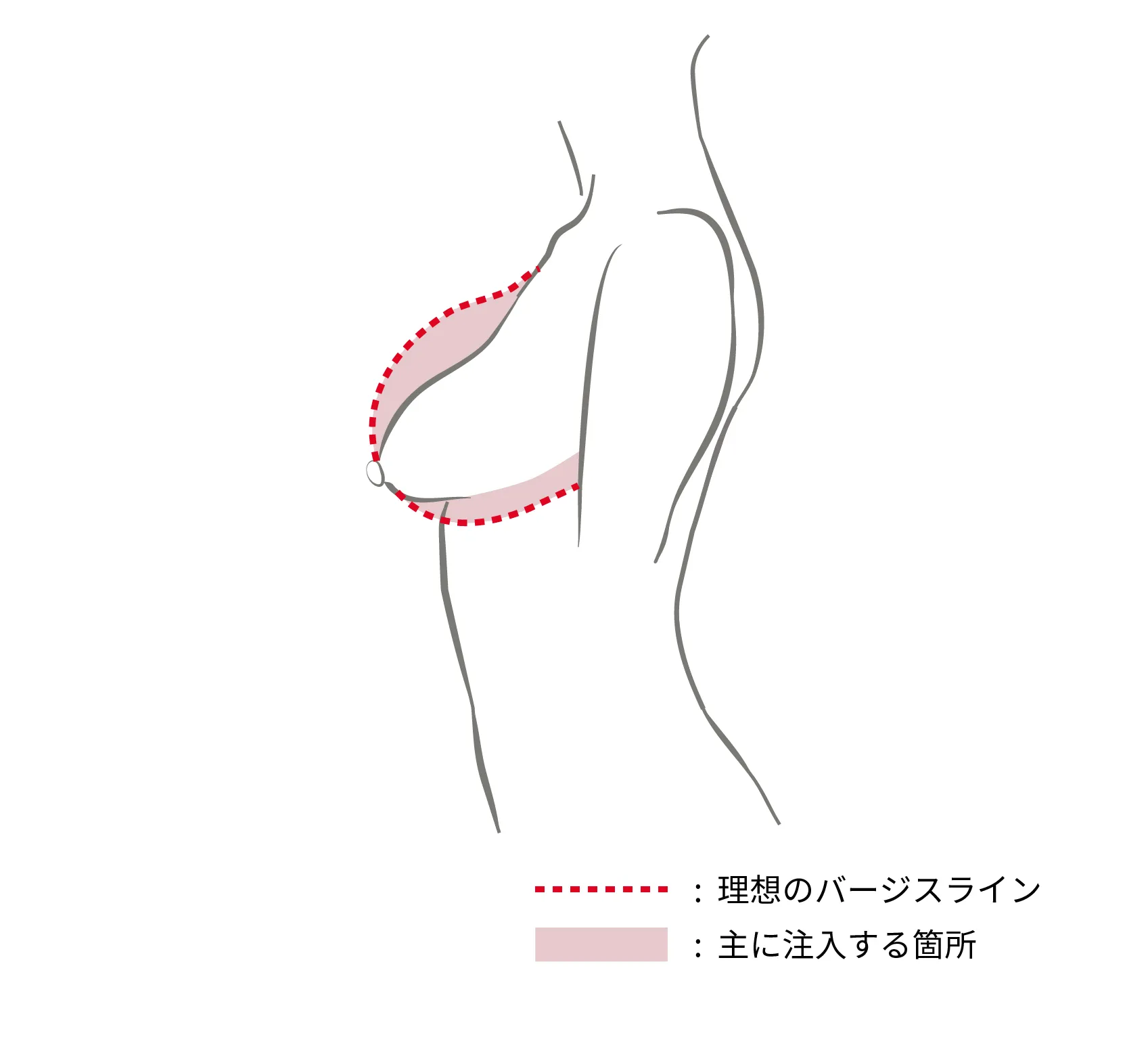 釣鐘型タイプ（注入ポイント）