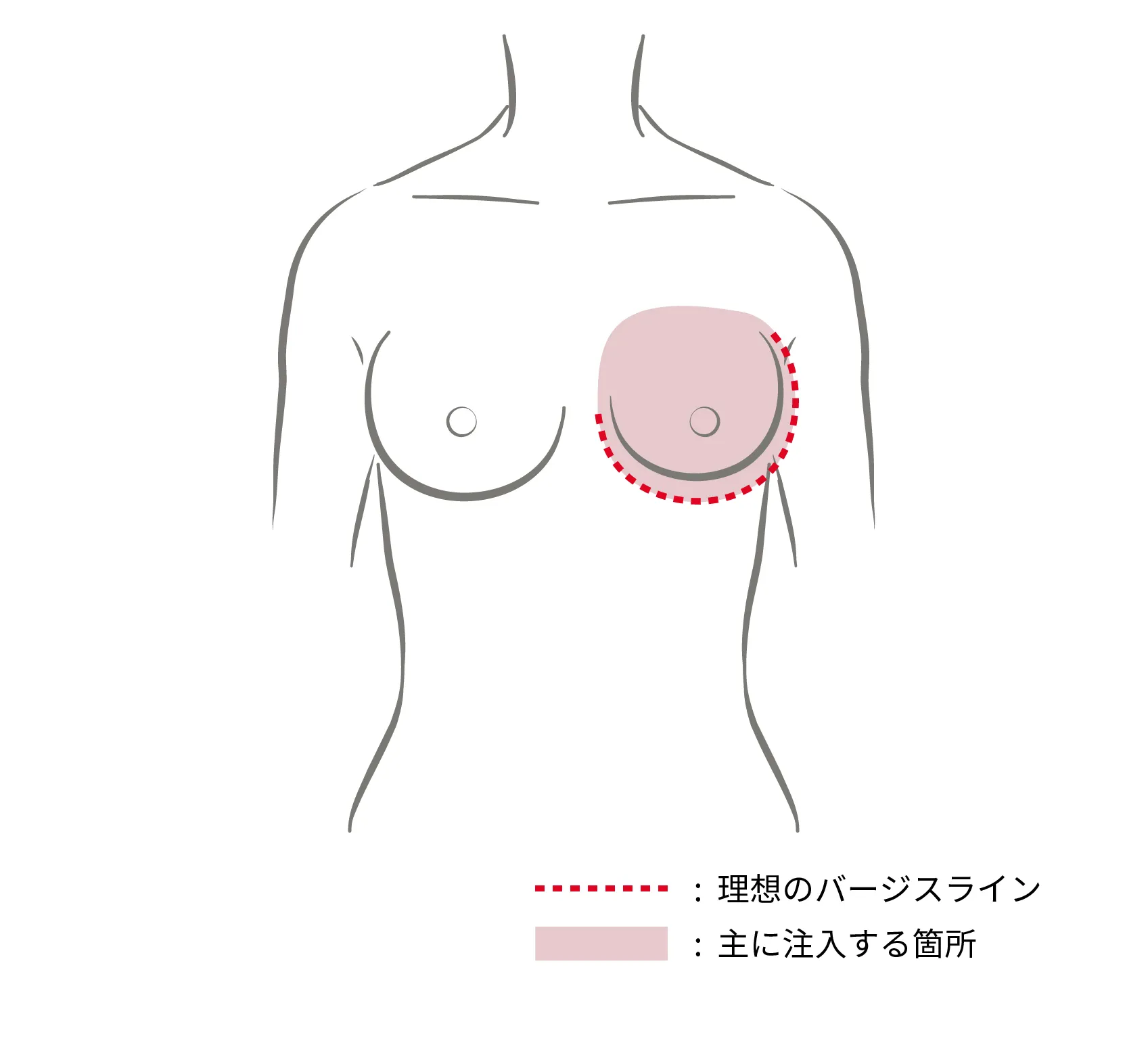 左右差タイプ（注入ポイント）
