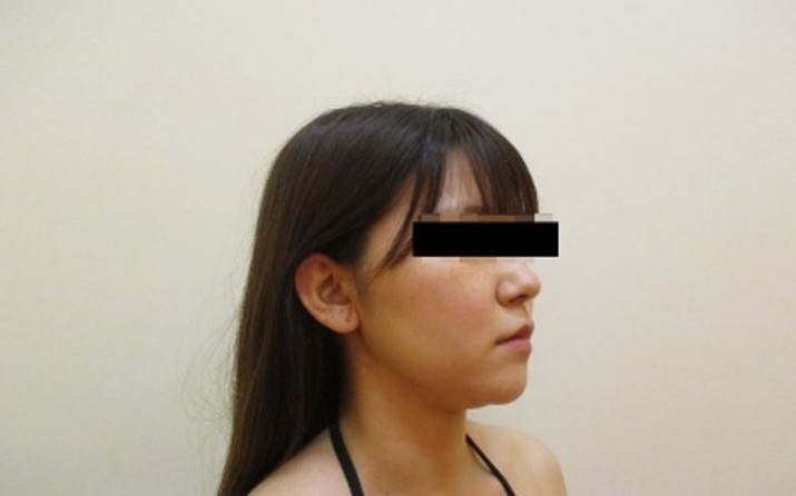 脂肪吸引の症例写真一覧