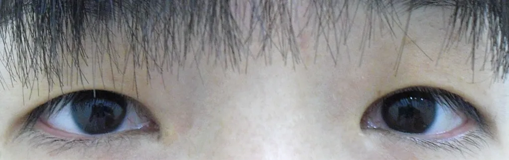 目・二重まぶたの症例写真一覧