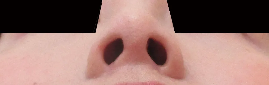 鼻・あごの症例写真一覧