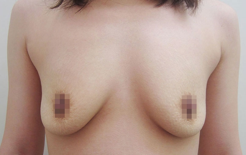 豊胸術の症例写真一覧