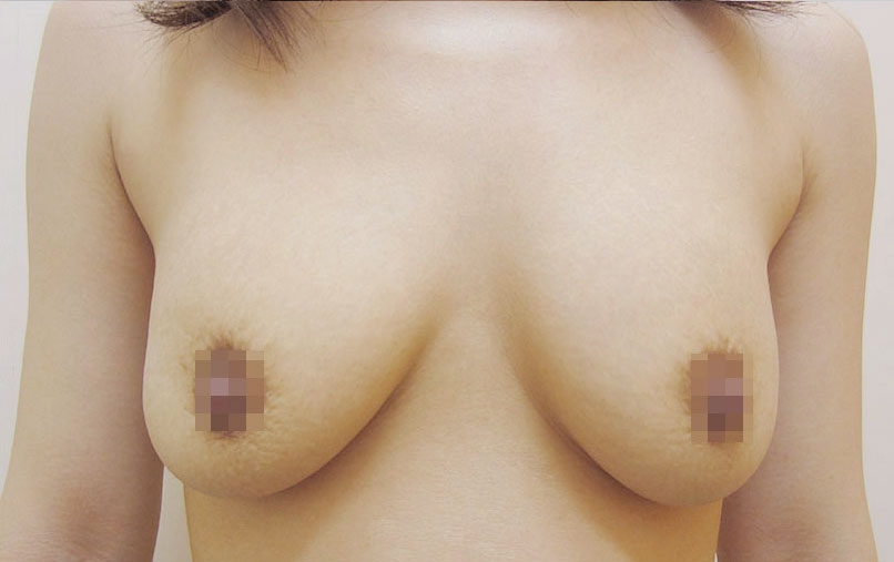 豊胸術の症例写真一覧