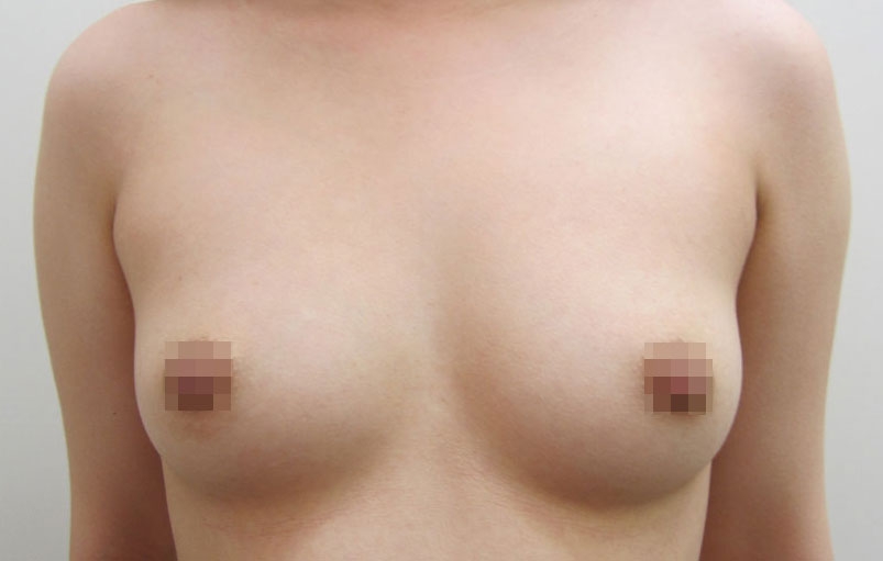 豊胸術の症例写真一覧