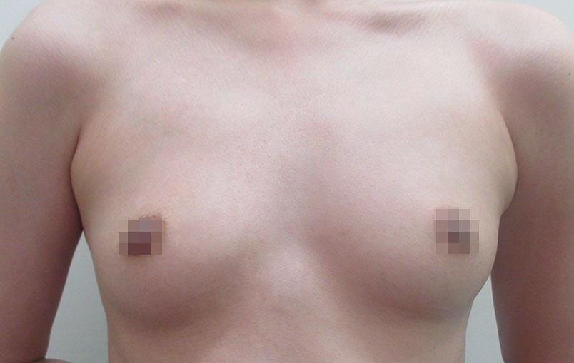 豊胸術の症例写真一覧