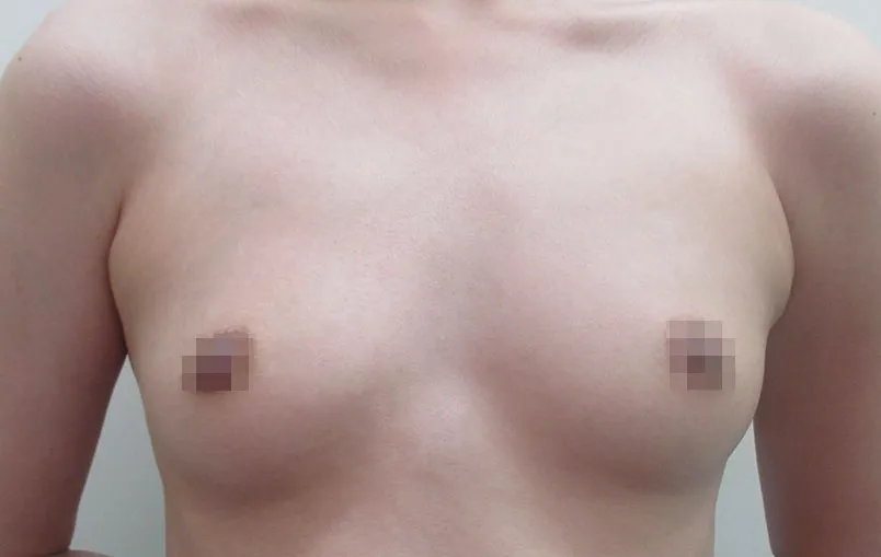 豊胸術の症例写真一覧