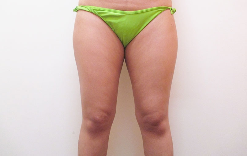 脂肪吸引の症例写真一覧