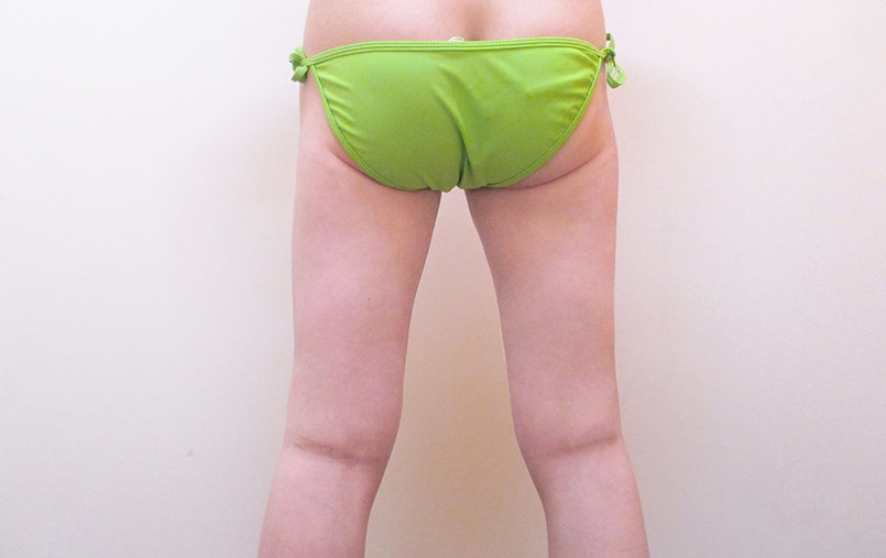 脂肪吸引の症例写真一覧