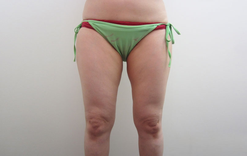 脂肪吸引の症例写真一覧