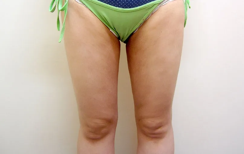 脂肪吸引の症例写真一覧