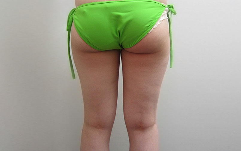 脂肪吸引の症例写真一覧