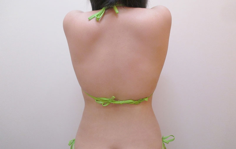 腰・背中の症例写真一覧