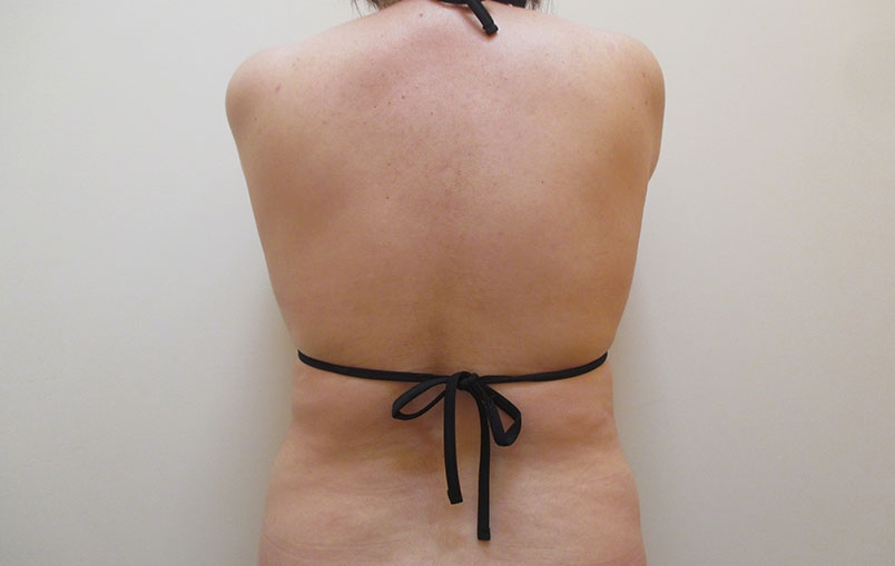 腰・背中の症例写真一覧