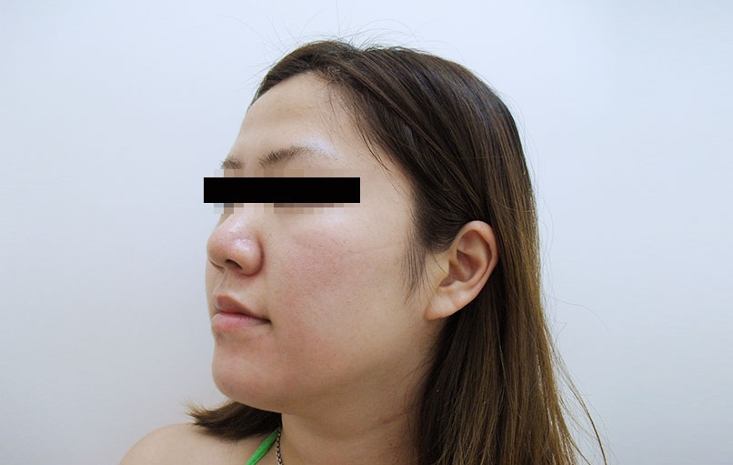 脂肪吸引の症例写真一覧