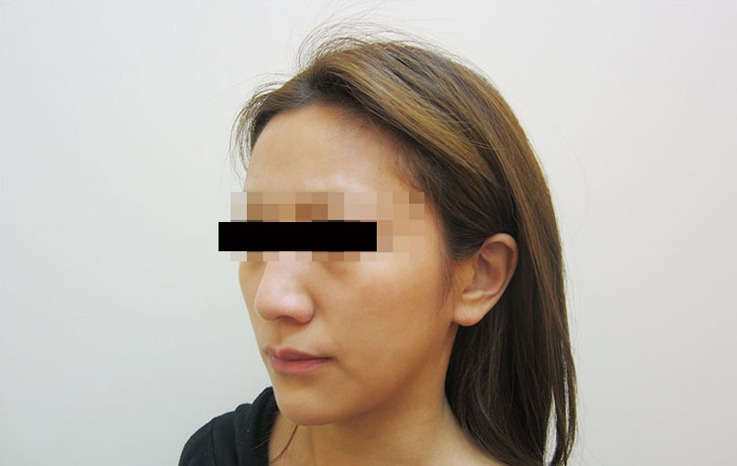 脂肪吸引の症例写真一覧