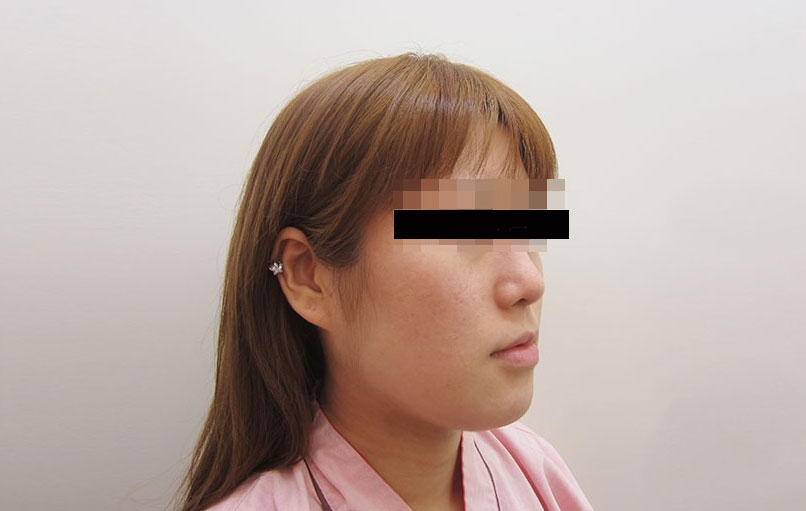 脂肪吸引の症例写真一覧