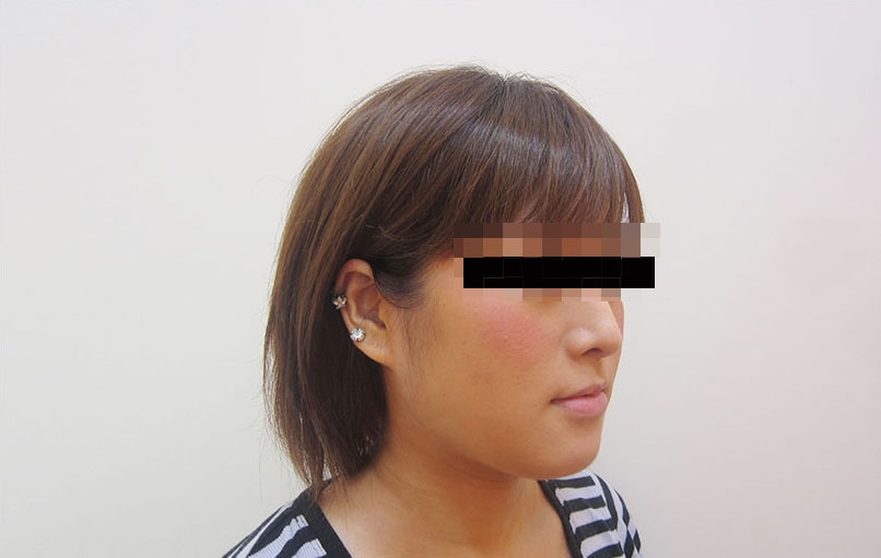 脂肪吸引の症例写真一覧
