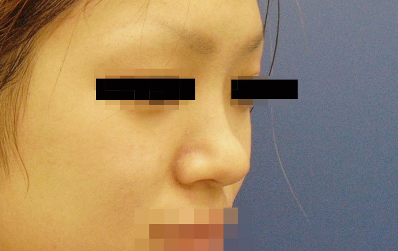 鼻・あごの症例写真一覧