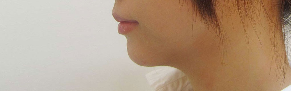 鼻・あごの症例写真一覧