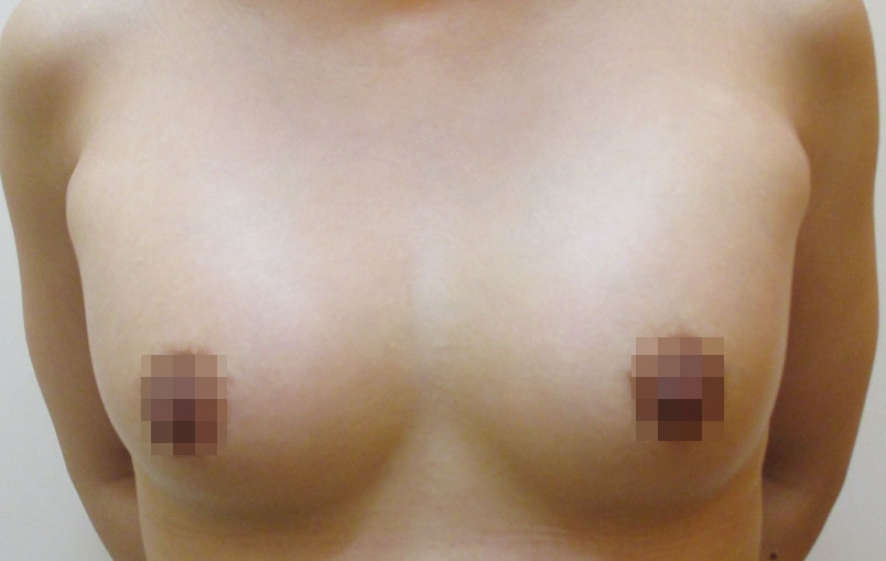 豊胸術の症例写真一覧
