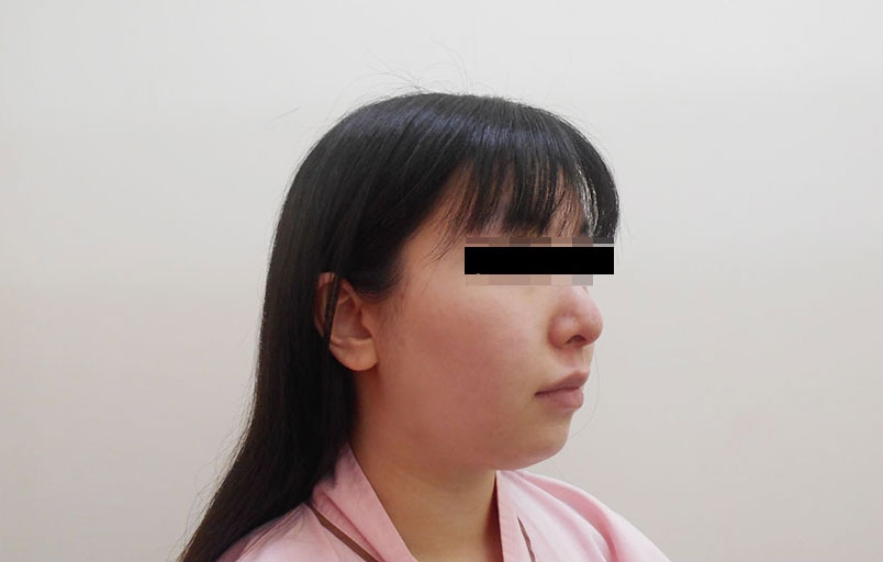 脂肪吸引の症例写真一覧