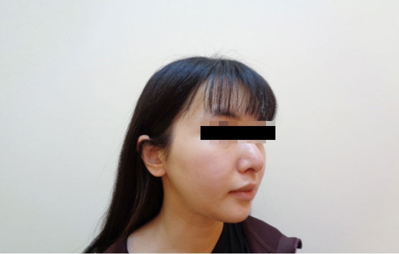 脂肪吸引の症例写真一覧