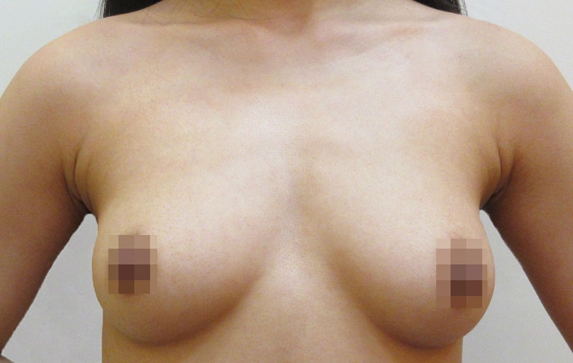 豊胸術の症例写真一覧