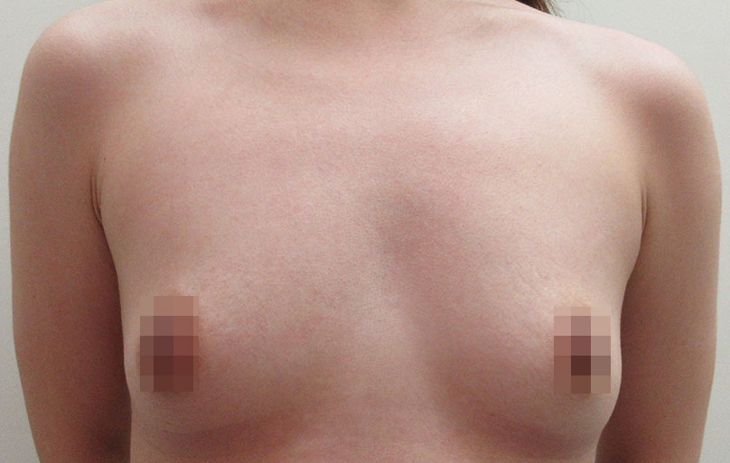 豊胸術の症例写真一覧
