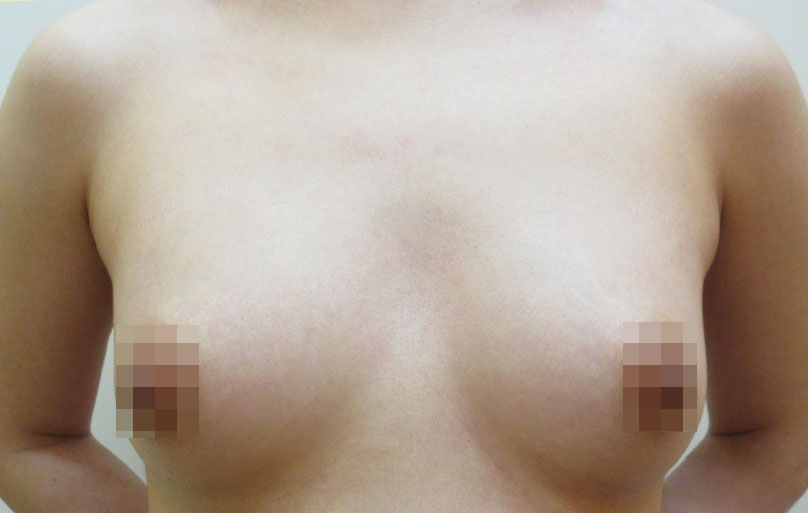 豊胸術の症例写真一覧