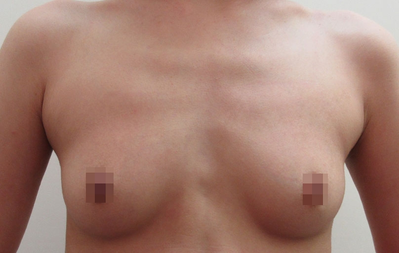豊胸術の症例写真一覧