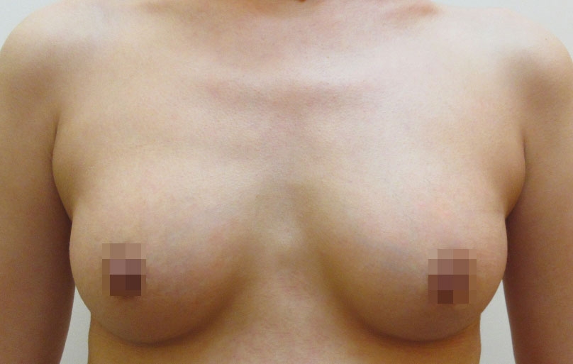 豊胸術の症例写真一覧