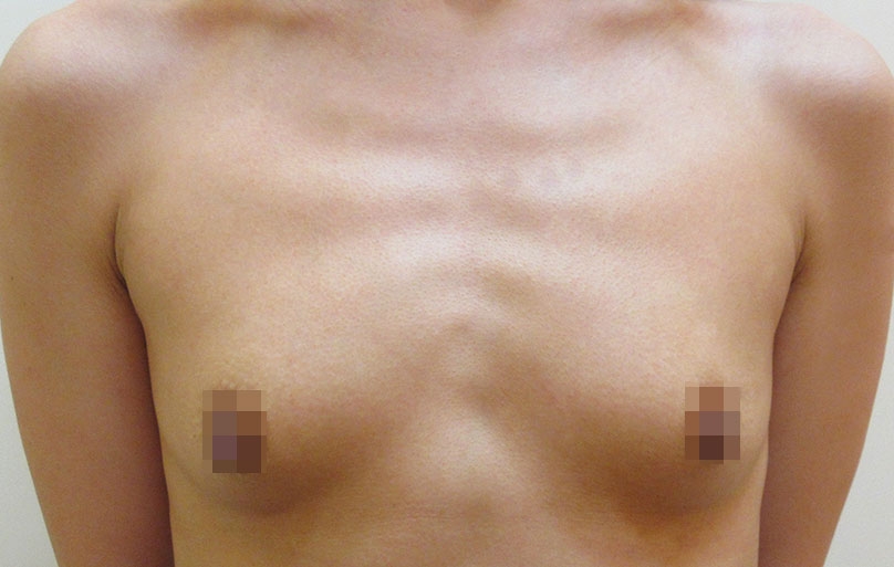 豊胸術の症例写真一覧