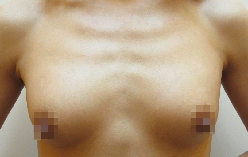 豊胸術の症例写真一覧