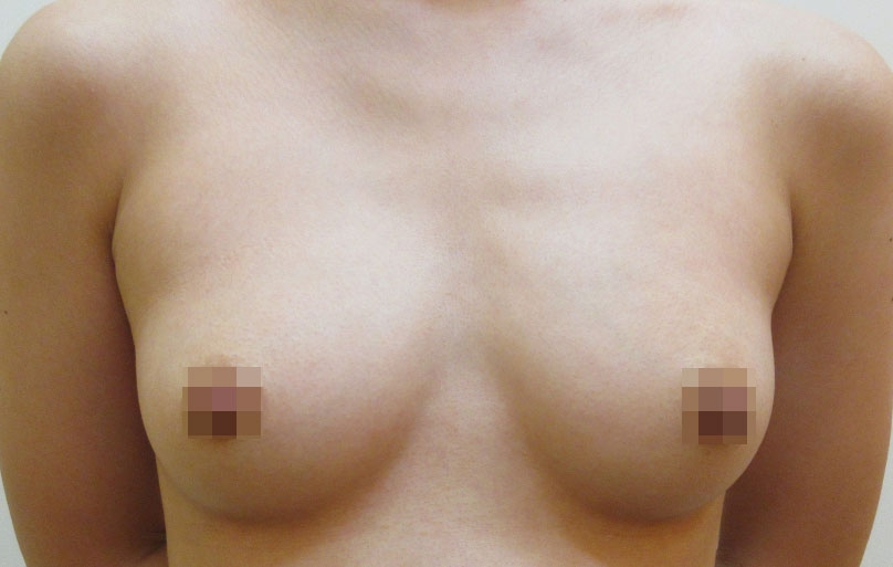 豊胸術の症例写真一覧