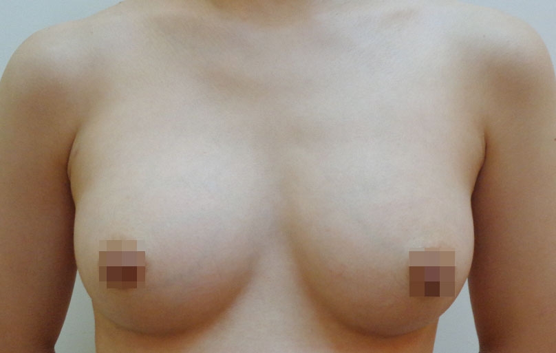 豊胸術の症例写真一覧