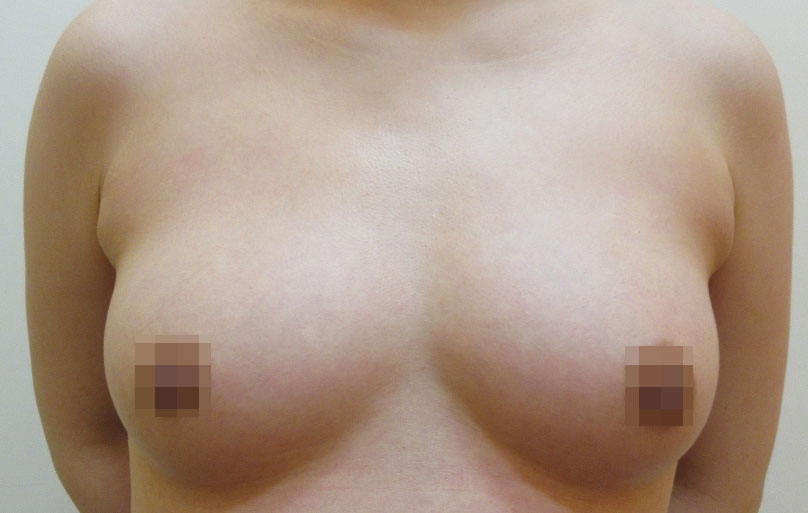 豊胸術の症例写真一覧