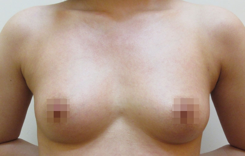 豊胸術の症例写真一覧