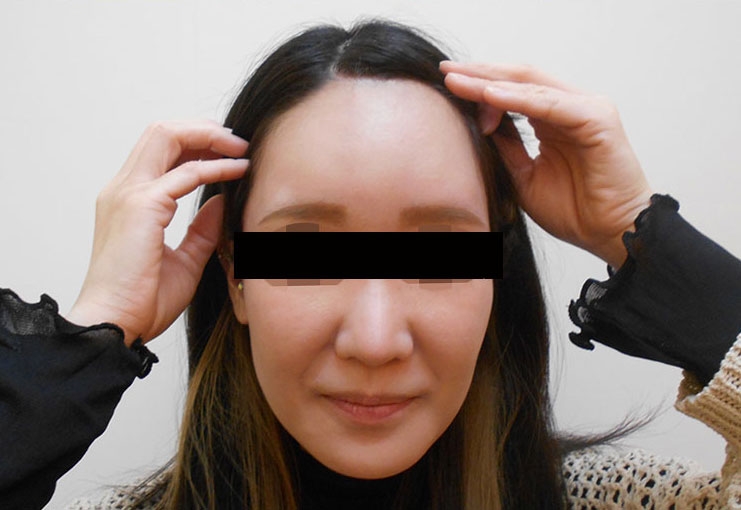 顔の脂肪注入の症例写真一覧