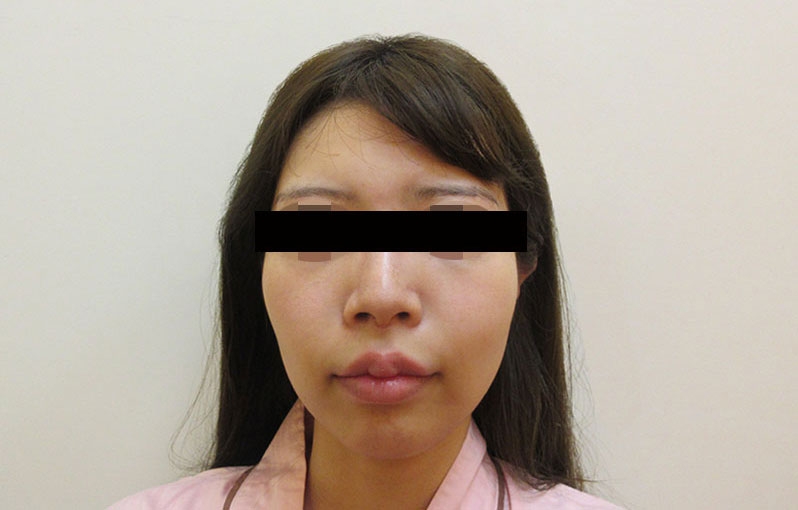 顔の脂肪注入の症例写真一覧